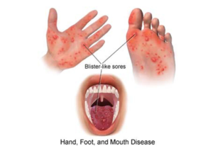 Health Ministry advises that children with Hand, Foot and Mouth Disease stay home